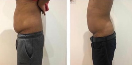 3D Lipo